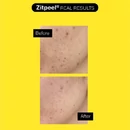 Acnemy-Zitpeel gyengéd hámlasztó  aknéra hajlamos bőrre-3