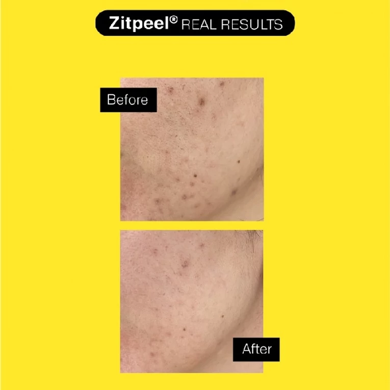 Acnemy-Zitpeel gyengéd hámlasztó  aknéra hajlamos bőrre-3