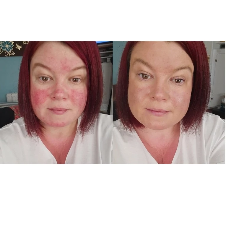 Rosalique 3 in 1 Anti-Redness Miracle Formula CC-krém rosaceás és érzékeny bőrre SPF505
